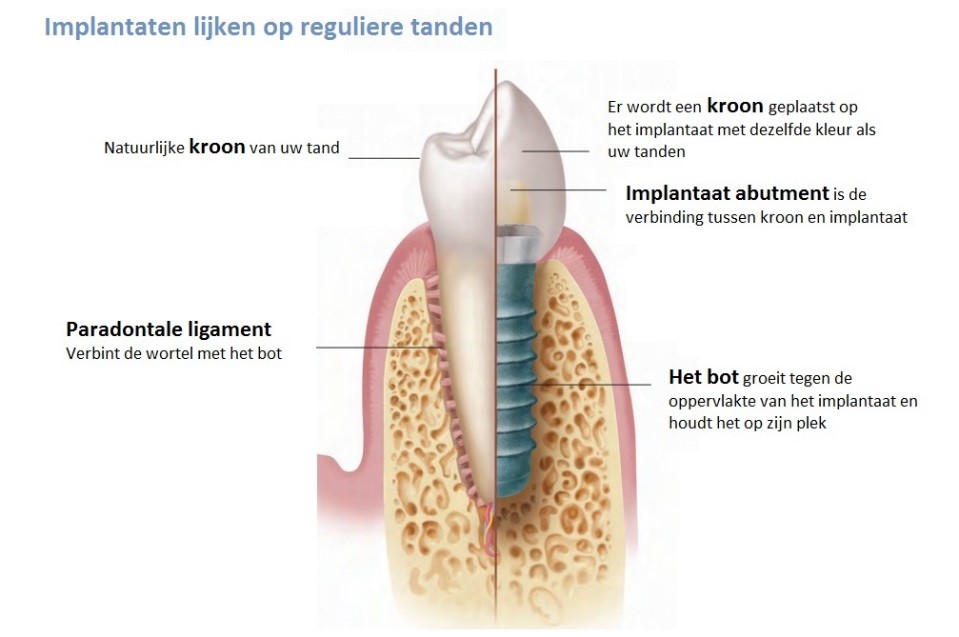Implantaten Den Haag